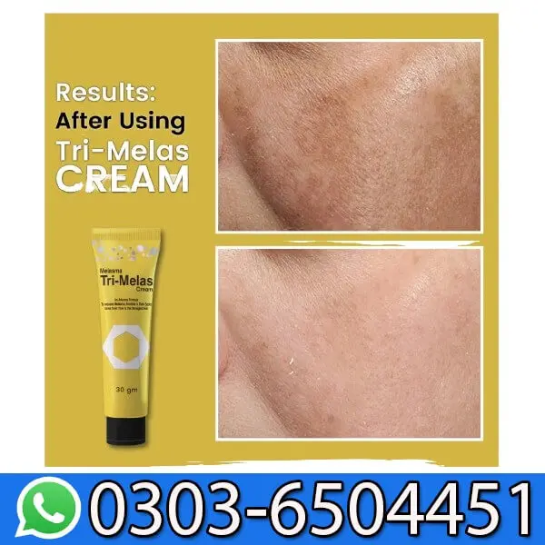 Dr Romia Tri Melas Melasma Cream In Pakistan